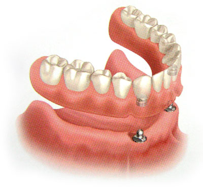Overdenture