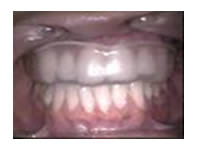 Protetor bucal transparente