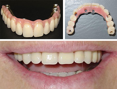 Reabilitação de desdentados através de um protocolo parafusado sobre implantes