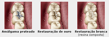 Restaurações