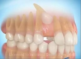 Tracionamento Dentes Inclusos